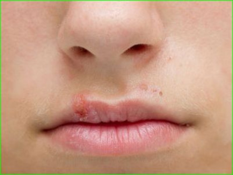 Herpes Labial (Foto: Reprodução Google)