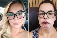 ALERTA - Mulher perde o lábio superior após realizar preenchimento-Veja no link do Instagram abaixo - Foto: Reprodução