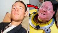 Homem que viveu com pulmão de ferro por 70 anos morre de covid nos Estados Unidos - Foto: Reprodução Internet uol - Do UOL, São Paul