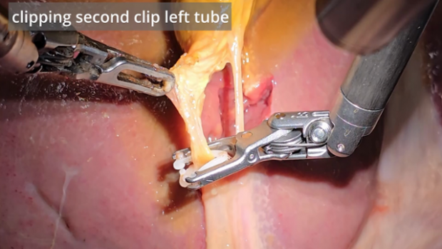Robô faz cirurgia orientado por IA e sem nenhuma assistência humana
