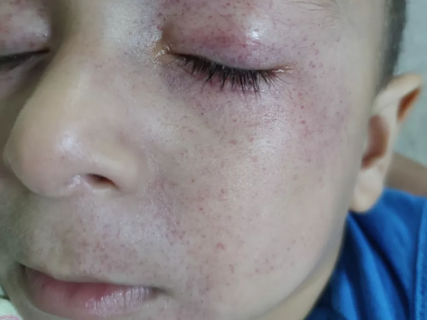 Petequias - marcas vermelhas na pele - provocadas pelo sufocamento (Foto: Arquivo pessoal)
