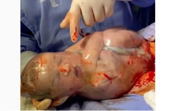 Bebê nasce empelicado em Rondônia e vídeo de médico rompendo a bolsa viraliza (Foto: Reprodução redes sociais)