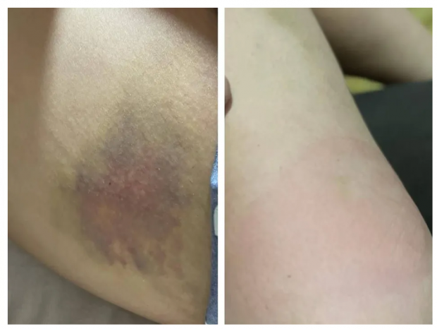 Marcas de agressores em Jaíne Marques (Foto: Arquivo Pessoal/Jaíne Marques)