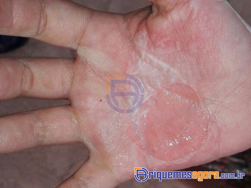 Mãe é Presa após Queimar mão de Filha com Colher Quente