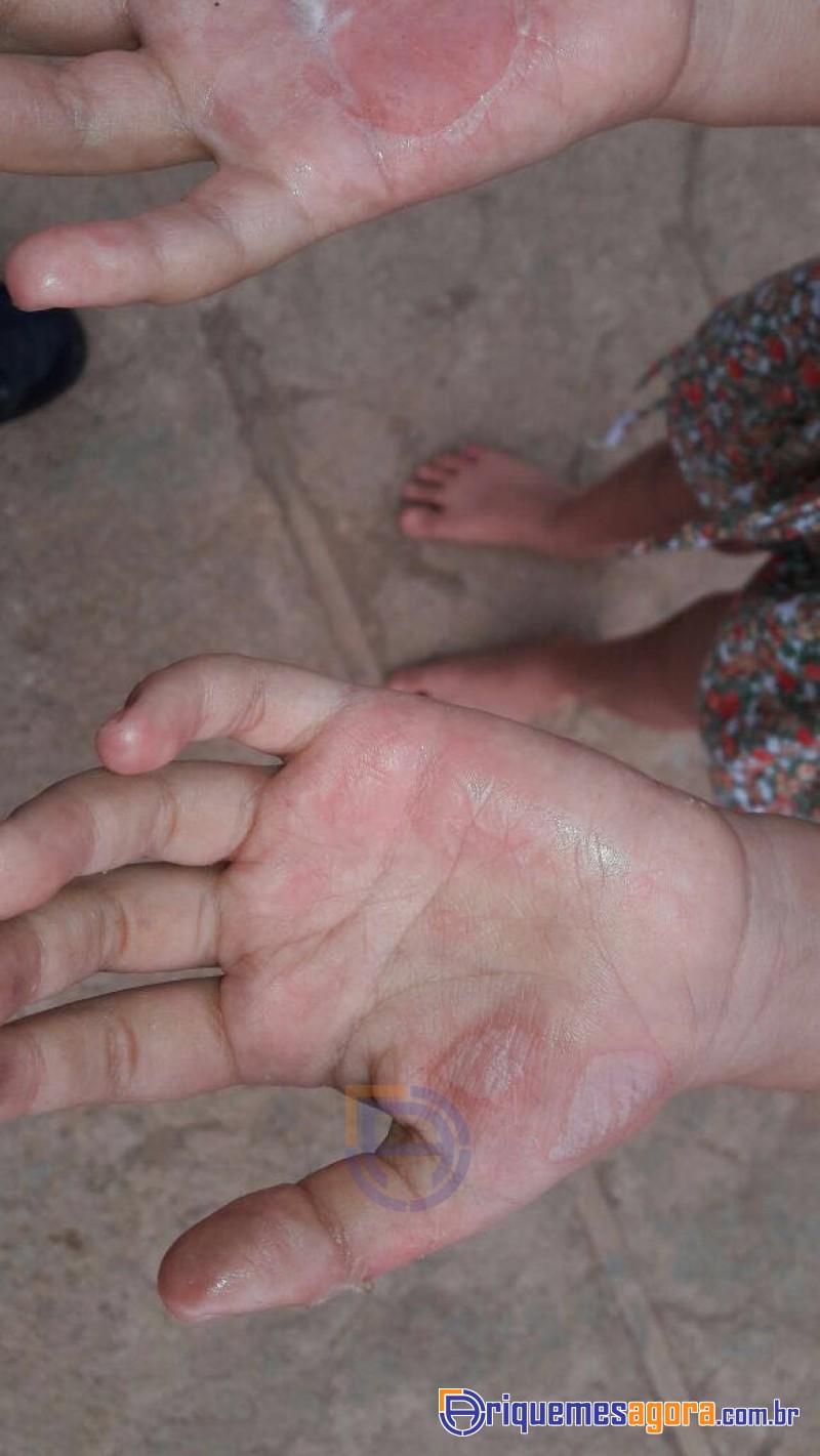 Mãe é Presa após Queimar mão de Filha com Colher Quente
