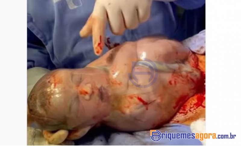 Bebê nasce empelicado em RO e vídeo viraliza: 'Foram ao meu médico pedir um parto como o meu'